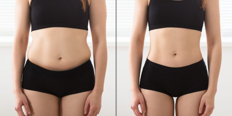 Smart Lipo: What Is It and How Does It Work?
