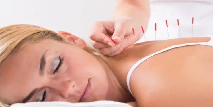 14 Benefits Of Acupuncture: The Mind/Body Connection