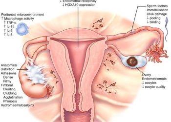 Gonal-f and endometriosis: How it can help to treat infertility