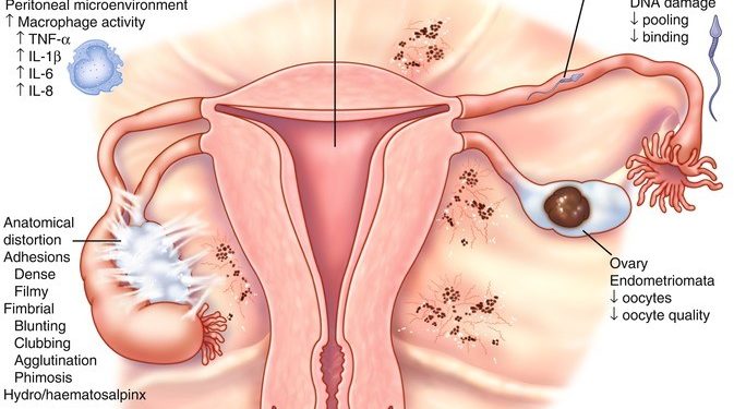 Gonal-f and endometriosis: How it can help to treat infertility