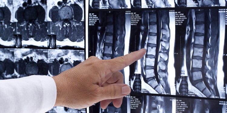 Spinal Cord Injury Law: What You Need to Know