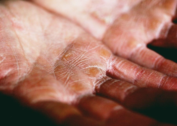 Can I Use a CBD Cream to Tame Eczema and Psoriasis Effectively?