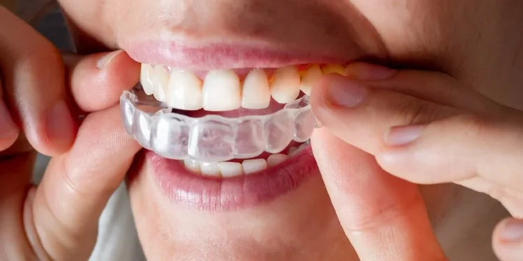 Can Aligners Treat an Overbite?