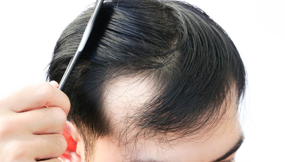 What Are Different Types Of Hair Loss You Can Find?