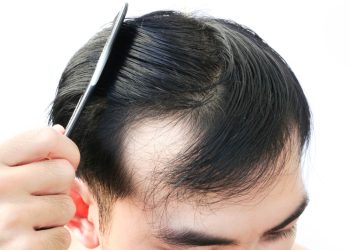What Are Different Types Of Hair Loss You Can Find?