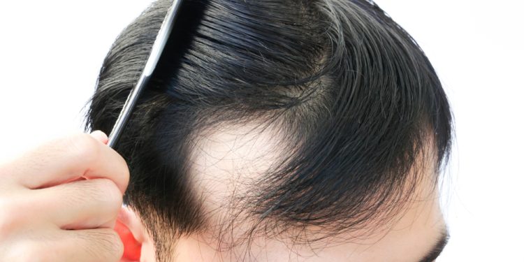 What Are Different Types Of Hair Loss You Can Find?