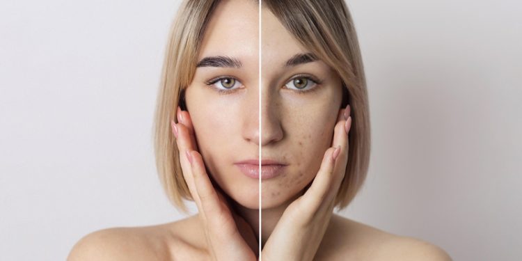 Understanding and Managing Acne Scars